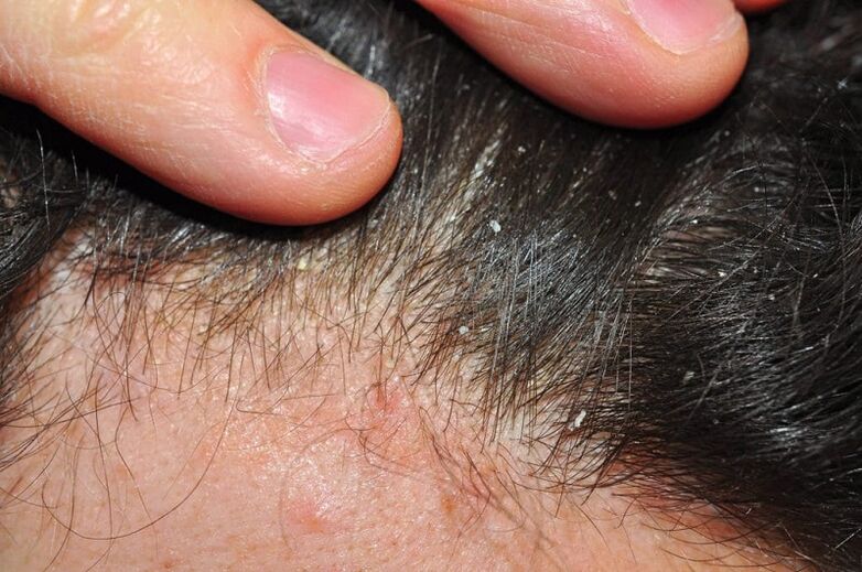 Psoriasis am Kopf wie es auf Haut und Kopfhaut aussieht, Behandlung mit Salbe und